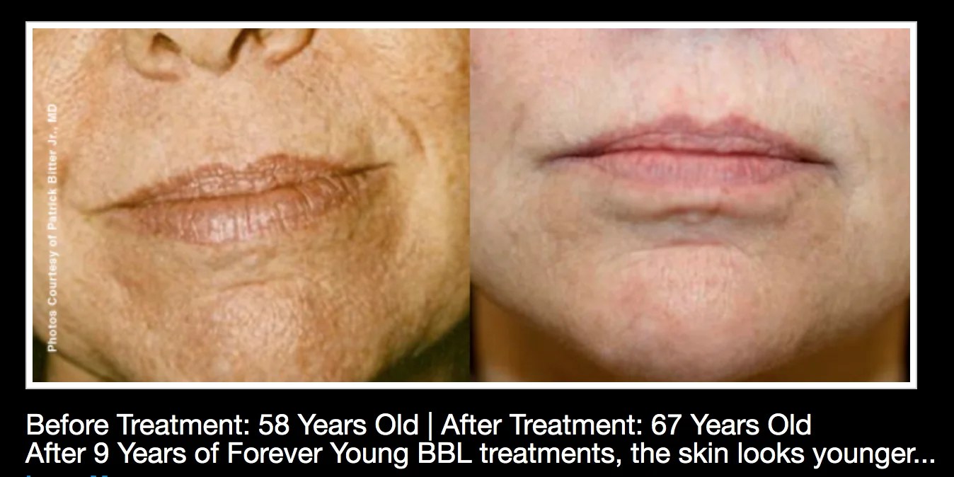 Before and after regular BBL treatment: Patient — age 58 to 67