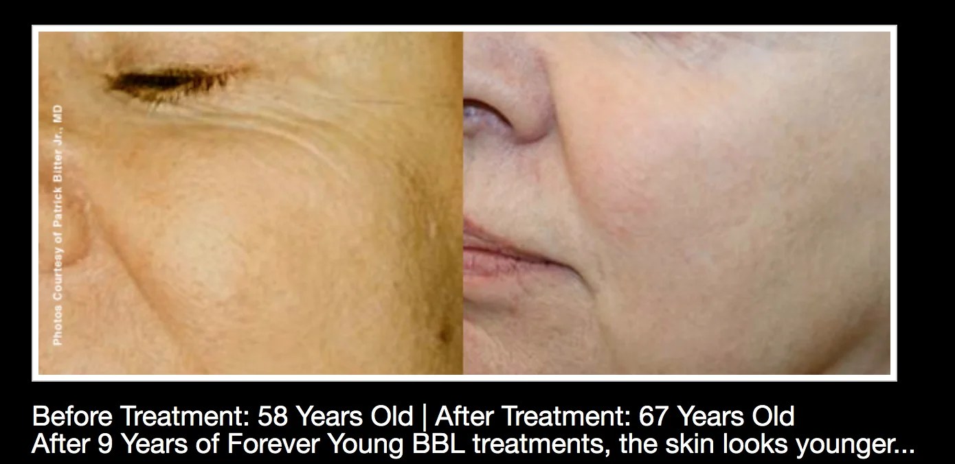 Before and after regular BBL treatment: Patient — age 58 to 67