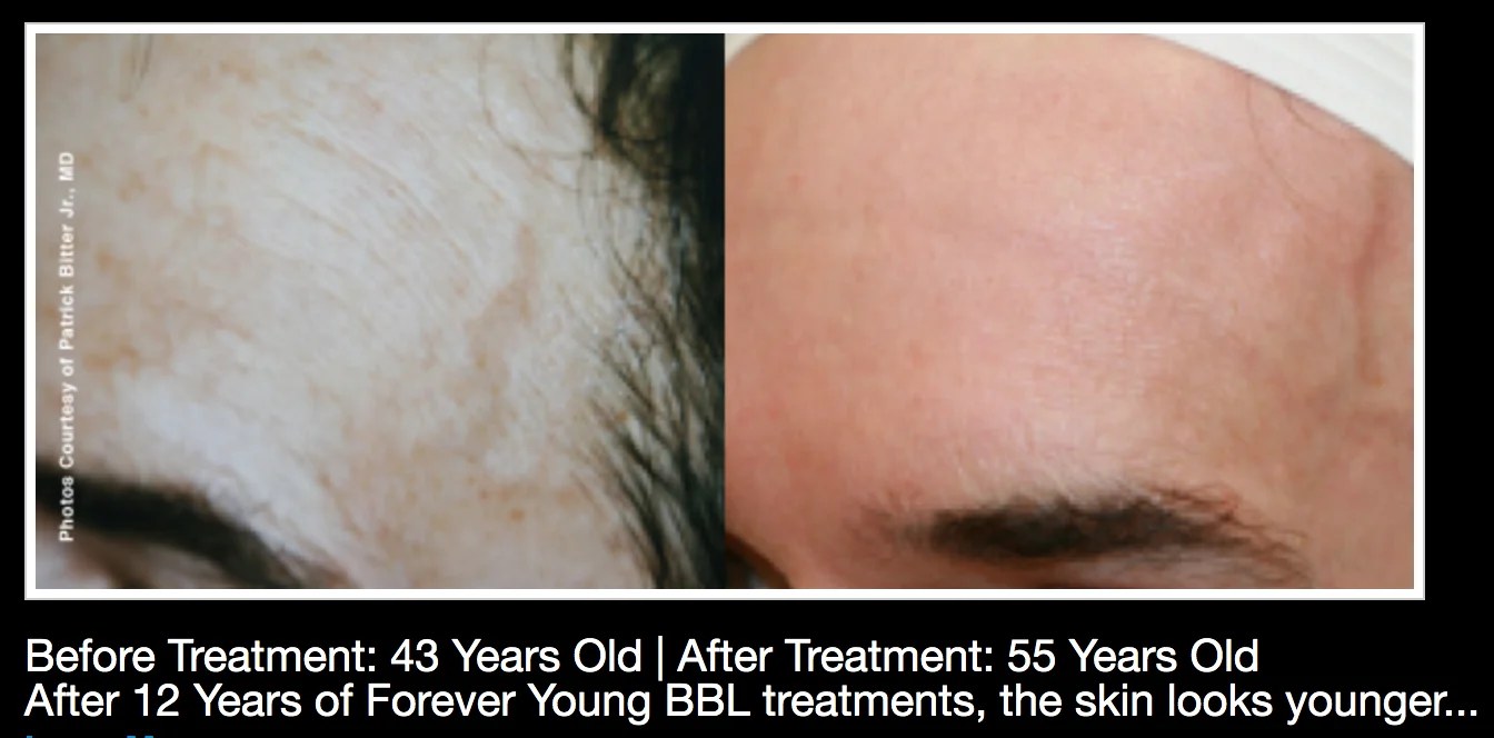 Before and after regular BBL treatment: Dr. Bitter’s own skin — age 43 to 55